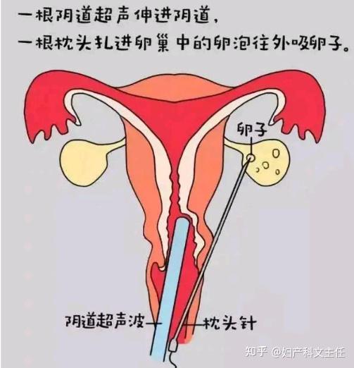 卵巢早衰能代生价格明细+卵巢早衰试管成功案例